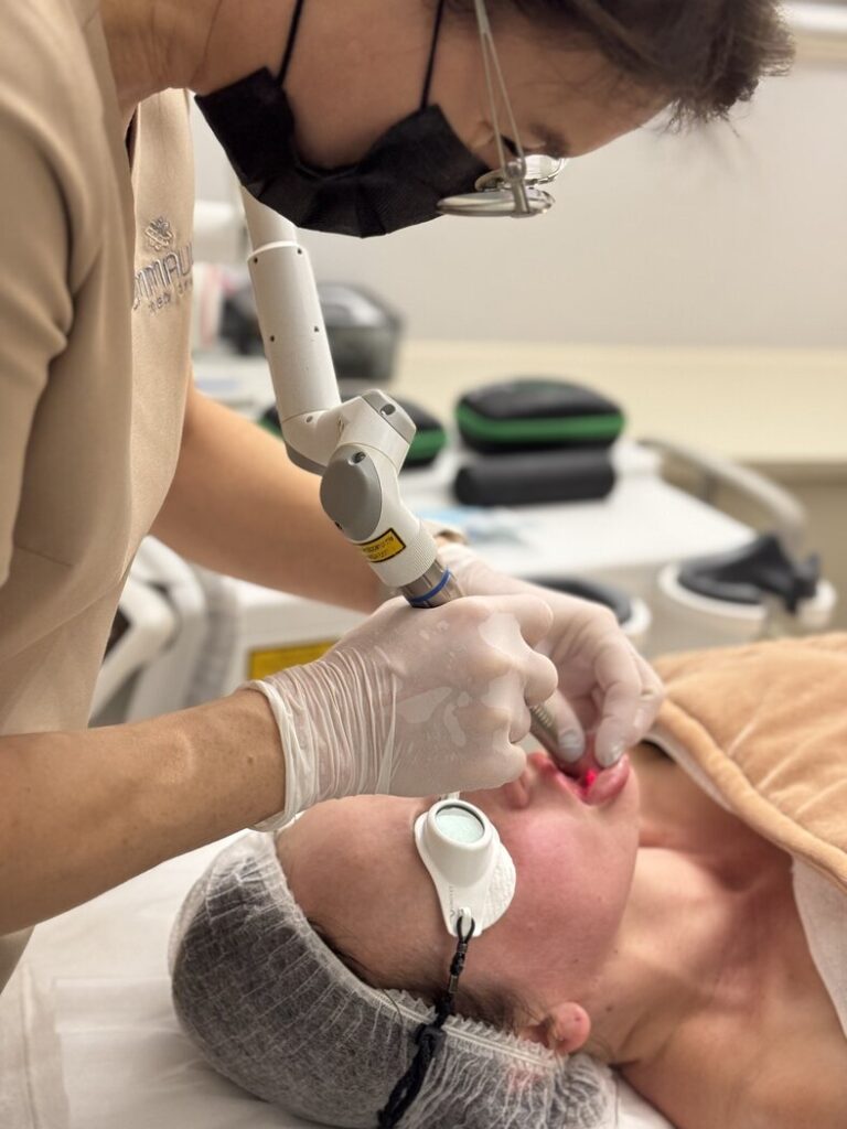 Laser Fototna - Endolifting twarzy Fotona 3D Kraków Endolifting